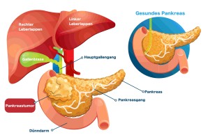 Pankreaskarzinom