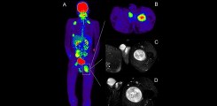 2.	A) Coronare Heatmap und B) axiale Rekonstruktion einer PET/CT eines Patienten mit Neurofibromatose Typ 1. Beidseits cervical und subclaviculär, an der rechten Thoraxwand und in paravertebraler lumbaler Ausdehnung sowie im proximalen linken Oberschenkel zeigen sich stoffwechselaktive Tumore. C) In der MRT mit fettgesättigter T2-gewichteter Aufnahme Nachweis einer großen malignitätssuspekten Raumforderung im linken Oberschenkel mit ovalärer Konfiguration, teils unscharfer Begrenzung zum umgebenden Gewebe, fehlender lobulierter Struktur und heterogener Binnenstruktur. Lateral angedeutet zeigt sich ein geringfügiges peritumorales Ödem. D) In der Diffusionswichtung weist dieser Tumor eine Diffusionsstörung auf. In der histopathologischen Aufarbeitung erfolgte der Nachweis eines malignen peripheren Nervenscheidetumors (MPNST).