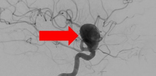 Großes Aneurysma