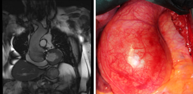 Unterschiedliche Phänotypen der bikuspiden Aortopathie