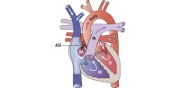 ASD | Vorhofseptumdefekt (Vorhofscheidewanddefekt)