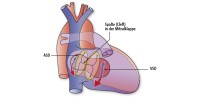 AVSD | Atrioventrikulärer Septumdefekt