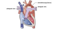 ISTA | Aortenisthmusstenose