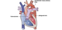 PDA | Persistierender Ductus arteriosus