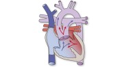 TAC | Truncus arteriosus communis