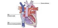 TGA | Transposition großer Arterien